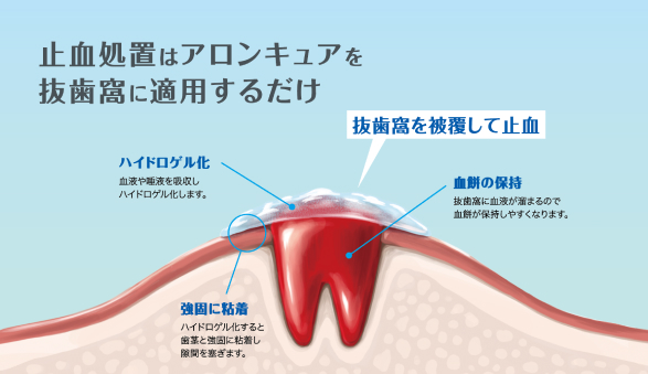 止血処置はアロンキュアを抜歯窩に適用するだけ